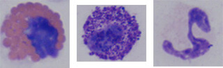 BAL cytology samples